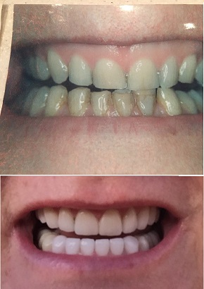 veneers