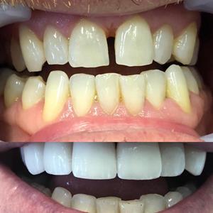 veneers2
